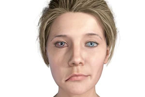 Bells Palsy