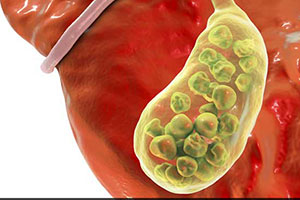 Gallbladder Stones