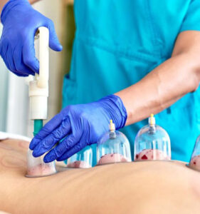 Hijama Wet Cupping Therapy at Maryam Health Care