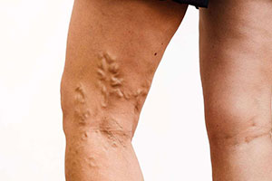Varicose Vein